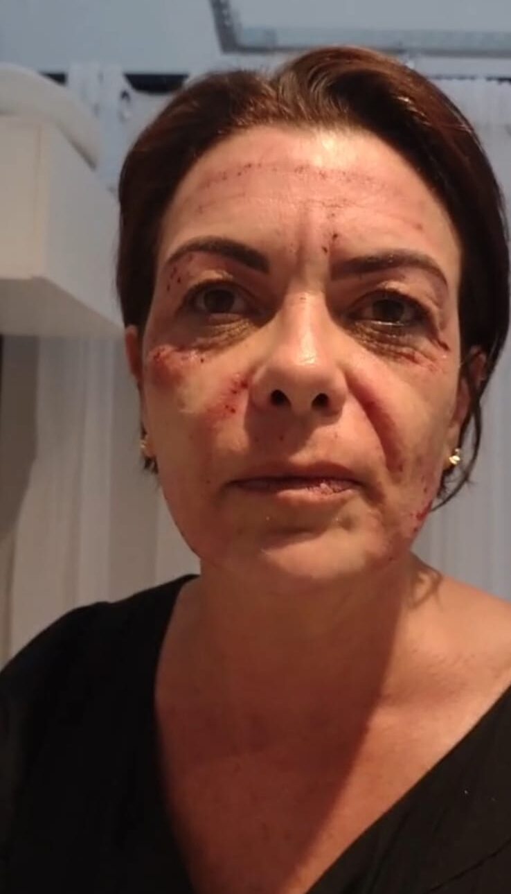 Jato de Plasma no Icaraí, Niterói | Bella Pele Depilação