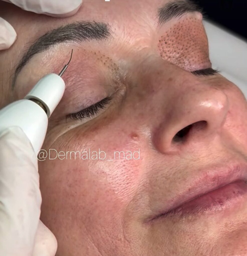 Jato de Plasma – Bella Pele Depilação, Niterói - RJ